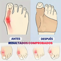 Corrector de Juanetes OrthoFlex™ 🦶✨