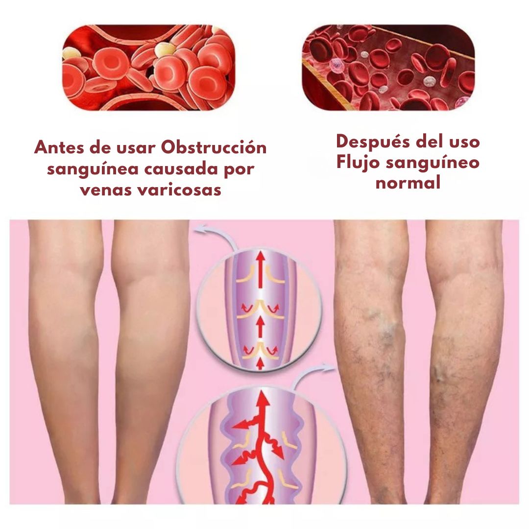 🌿 Crema para Piernas Varicose Comfort™ 🦵✨